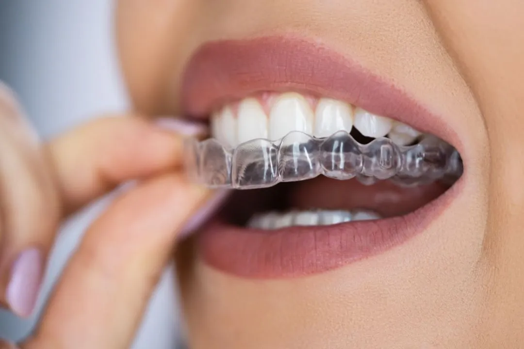 890636c4-ddba-47fe-b449-a31b49d05fd2-Clear_Aligners_W6SVhByTK